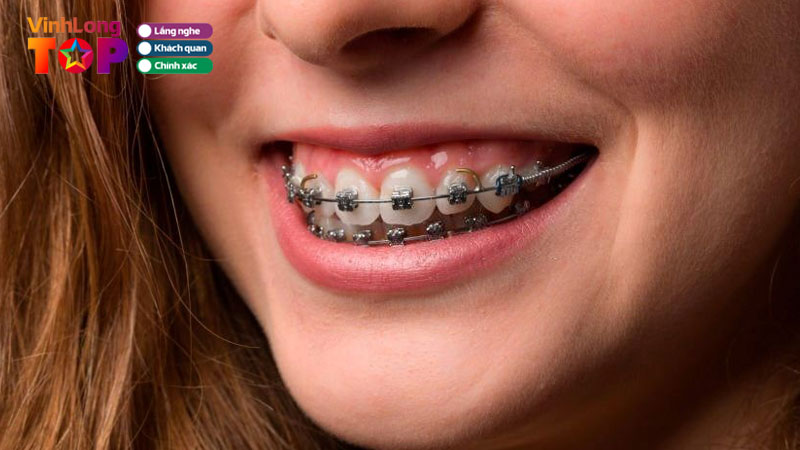 Top-10-dia-chi-nieng-rang-tai-vinh-long-uy-tin-co-tra-gop-vinhlongtoplist